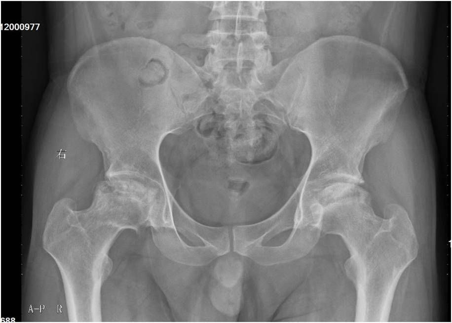 俊b:股骨头坏死又称股骨头缺血性坏死,是由于股骨头供血中断或受损