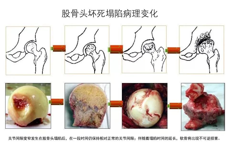 国内最常见的股骨头坏死原因是什么?如何早发现? - 啊坚道游戏网